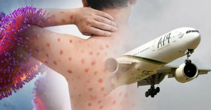 Monkeypox- New International rules for Flights